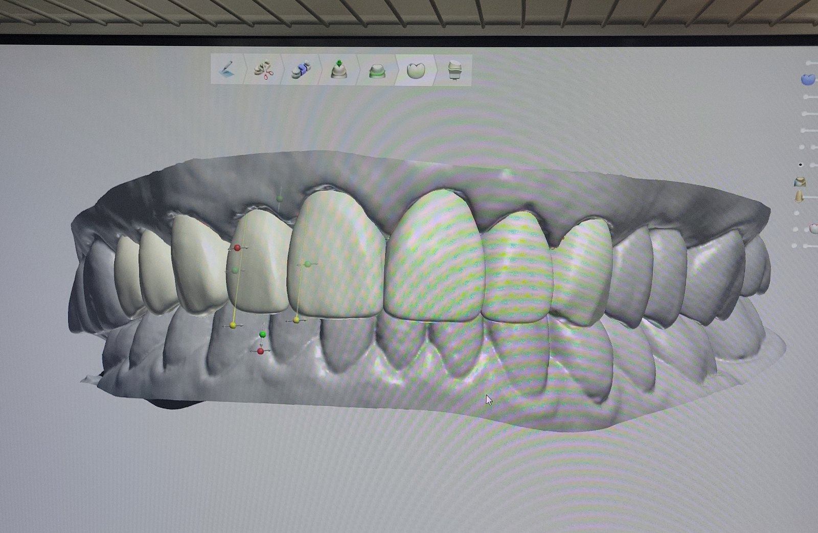 3Shape anterior CAD with Automate control points on a virtual model