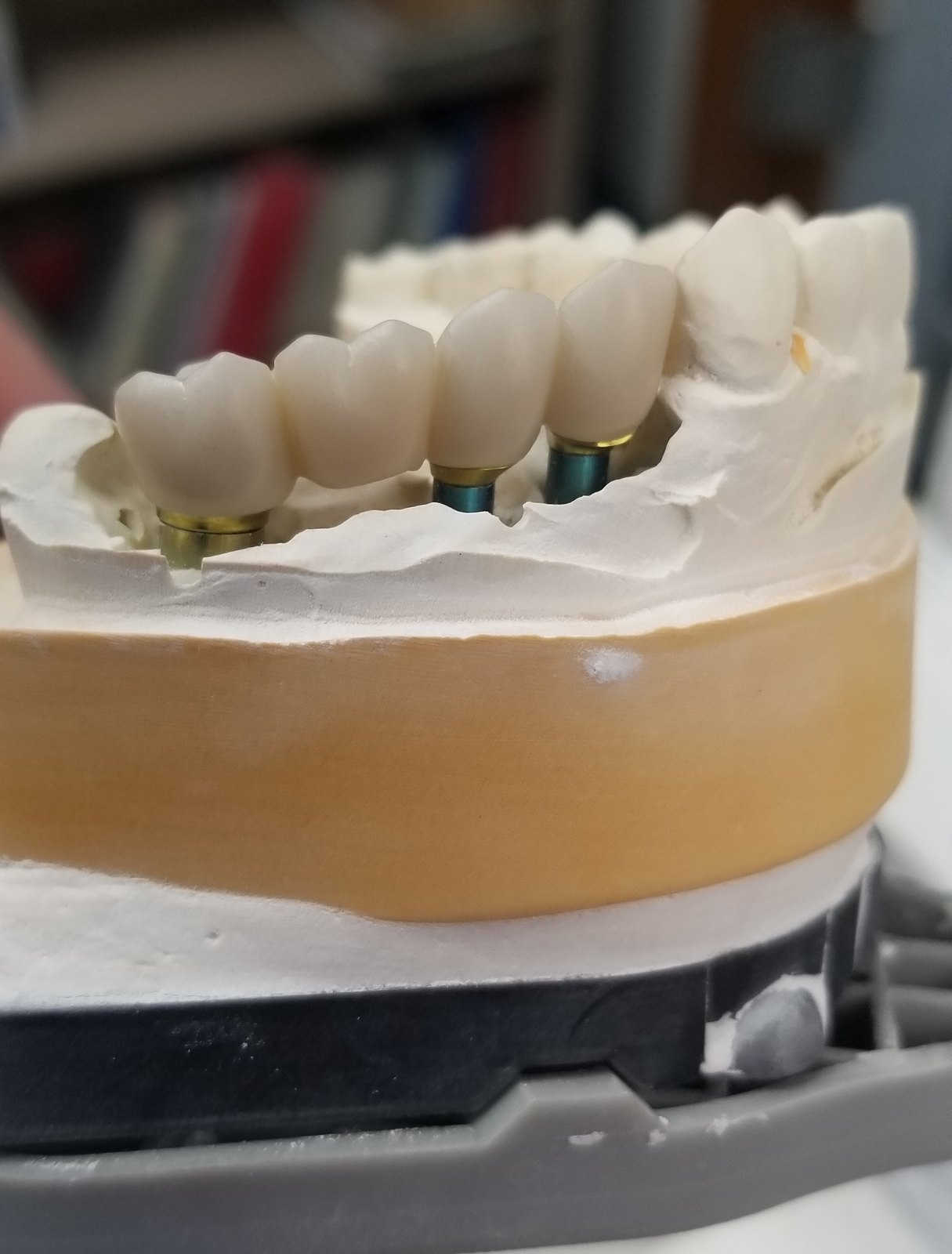 Screw-retained implant bridge seated on a stone model with analog abutments