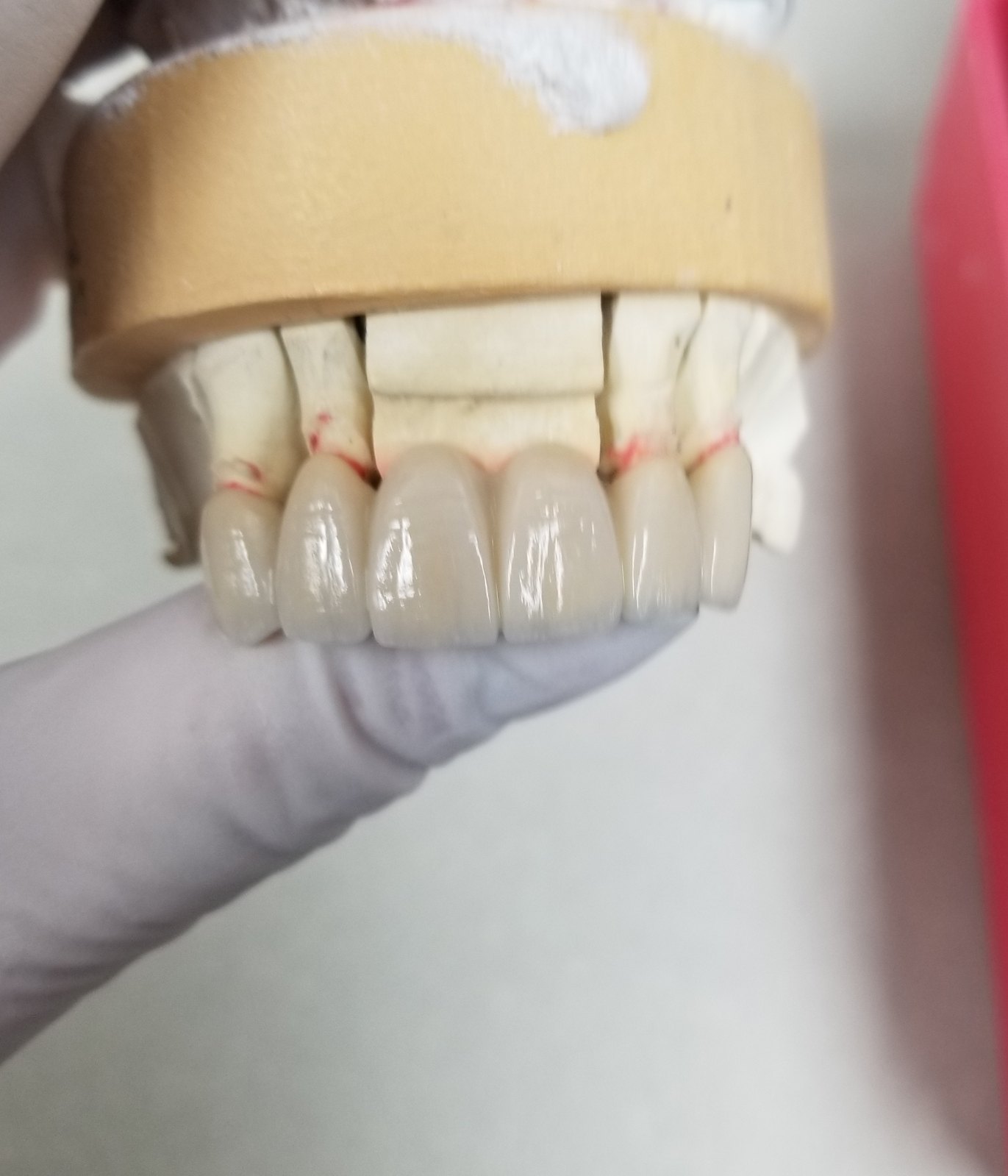 Four layered anterior porcelain-fused restorations on a gypsum model