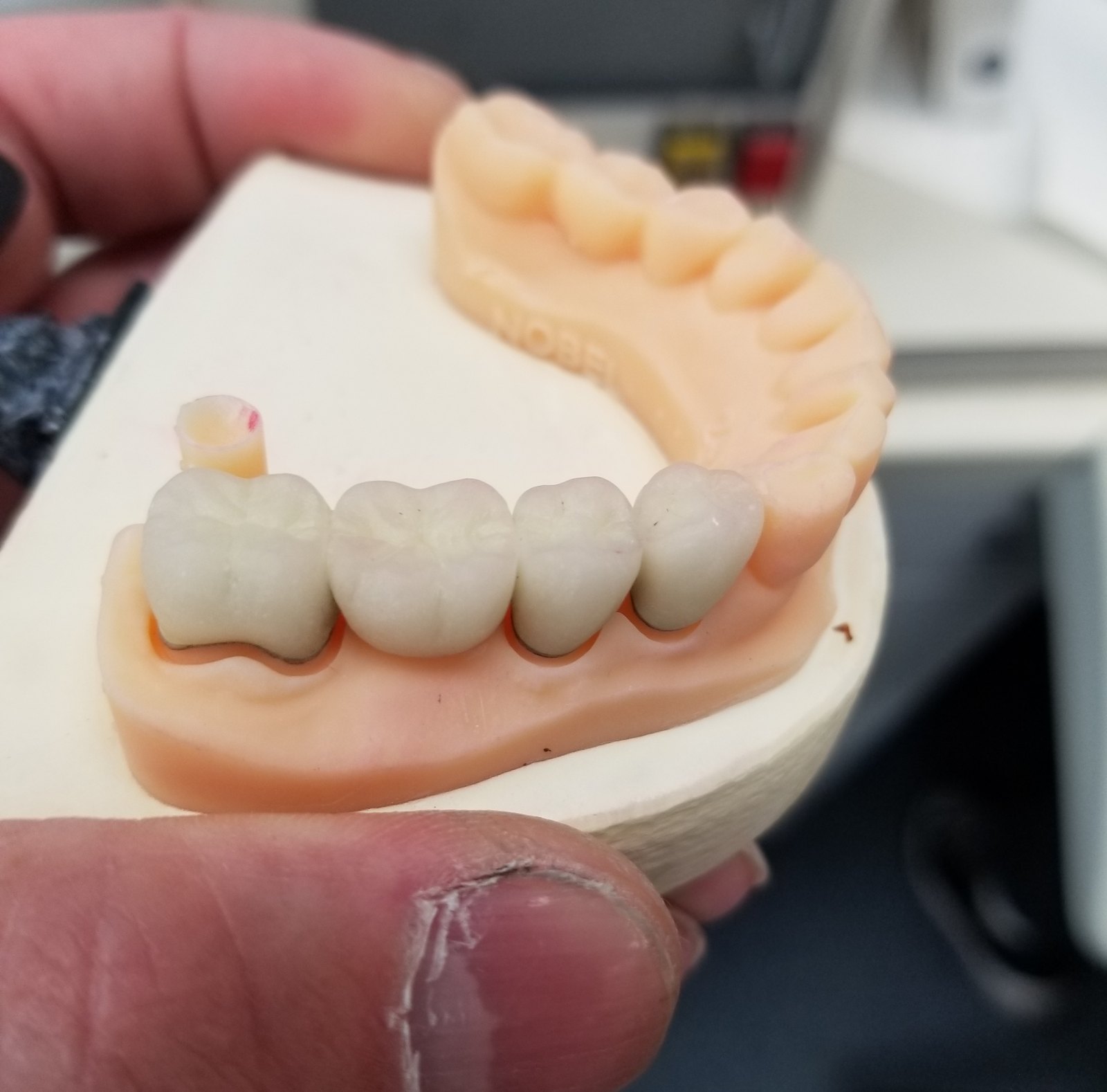 Four-unit porcelain posterior bridge seated on a printed working model