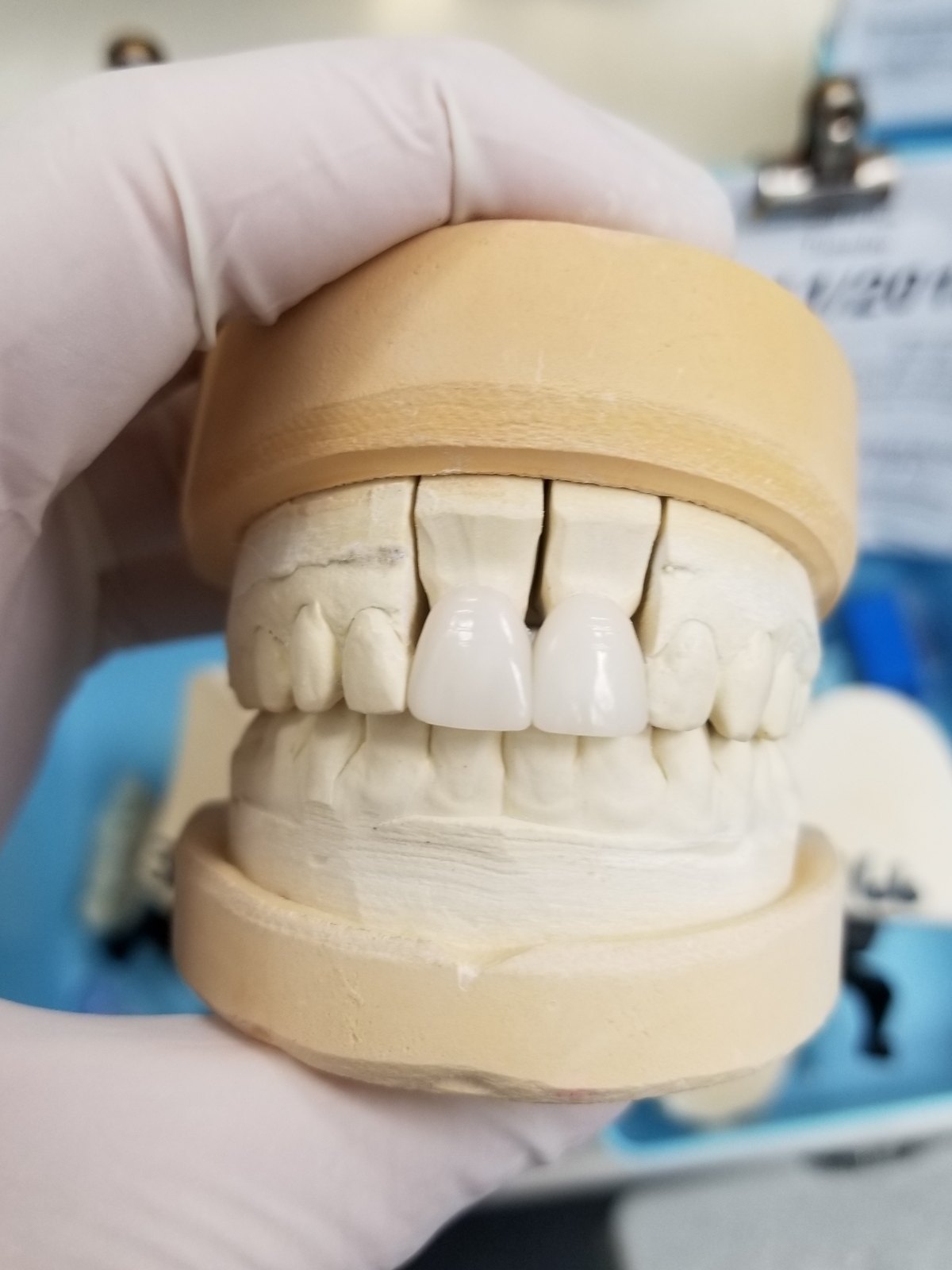 Two layered porcelain anterior crowns on a stone model